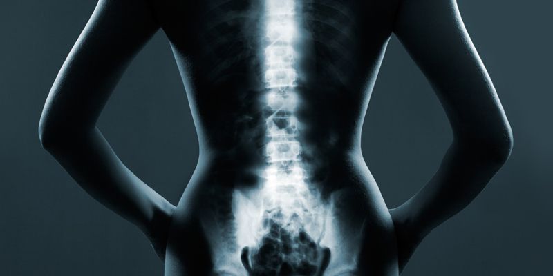 herniated