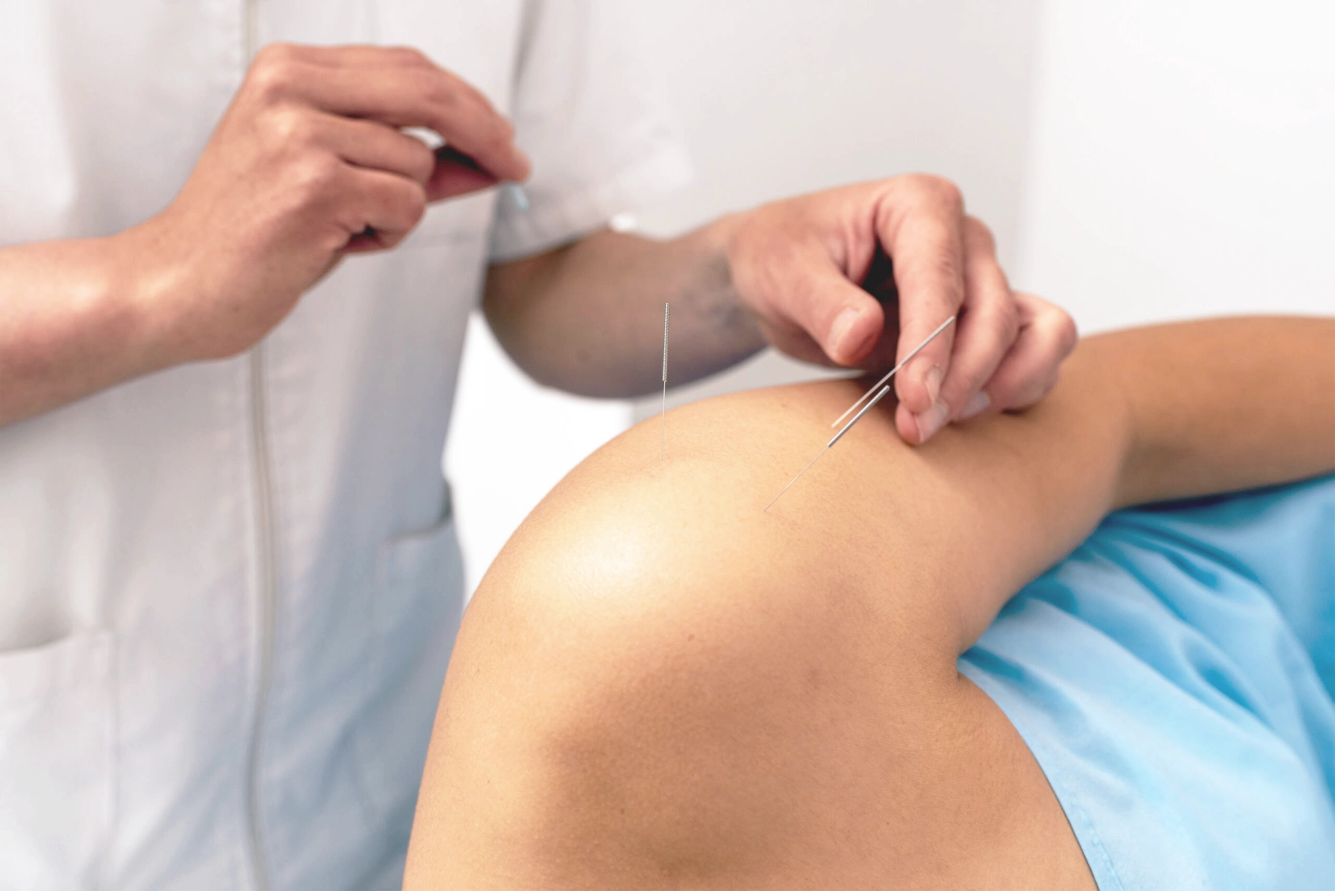 dry needling