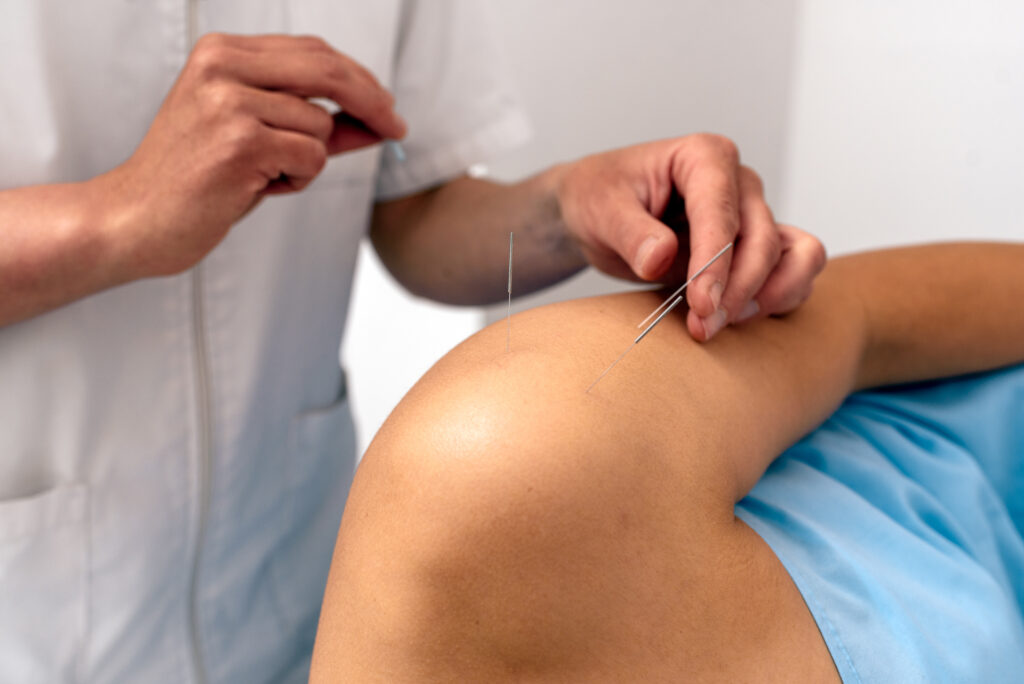 Dry Needling